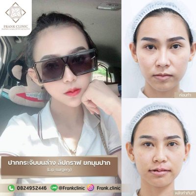 รีวิว ศัลยกรรม ปากกระจับ (Lip surgery)