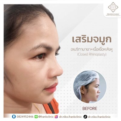 รีวิว เสริมจมูก (Rhinoplasty)