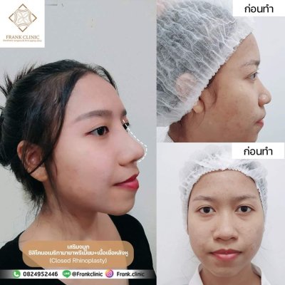 รีวิว เสริมจมูก (Rhinoplasty)