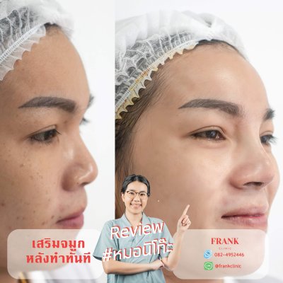 รีวิว เสริมจมูก (Rhinoplasty)