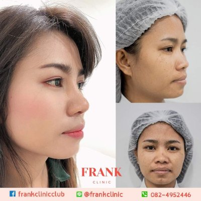 รีวิว เสริมจมูก (Rhinoplasty)