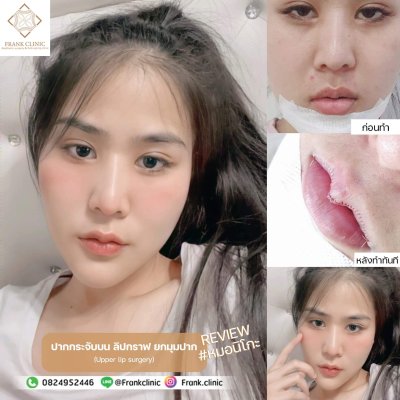 รีวิว ศัลยกรรม ปากกระจับ (Lip surgery)