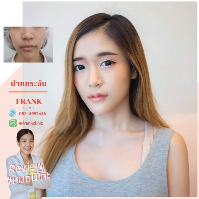 รีวิว ศัลยกรรม ปากกระจับ (Lip surgery)