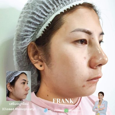 รีวิว เสริมจมูก (Rhinoplasty)