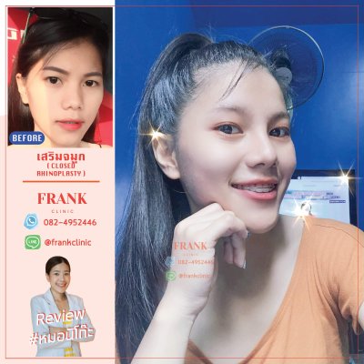 รีวิว เสริมจมูก (Rhinoplasty)