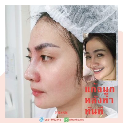 รีวิว เสริมจมูก (Rhinoplasty)