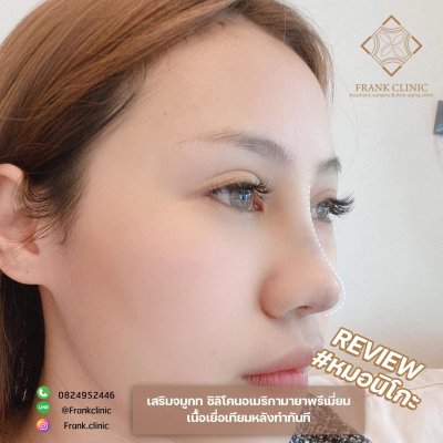 รีวิว เสริมจมูก (Rhinoplasty)