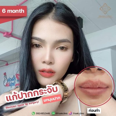 รีวิว ศัลยกรรมแก้ปากกระจับ 