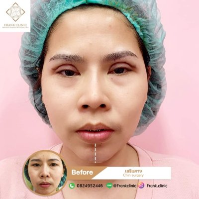 รีวิว เสริมคาง (Chin surgery)