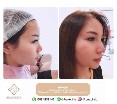 รีวิว เสริมจมูก (Rhinoplasty)