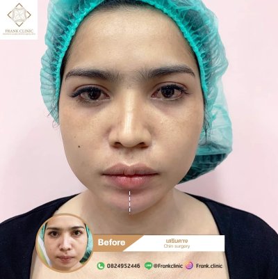 รีวิว เสริมคาง (Chin surgery)