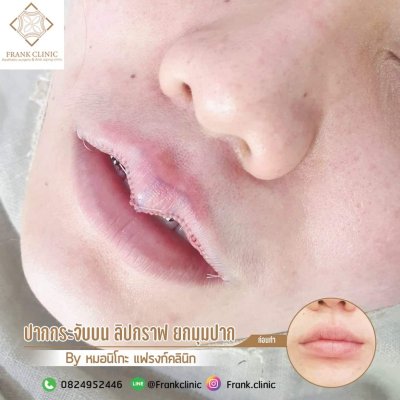 รีวิว ศัลยกรรม ปากกระจับ (Lip surgery)