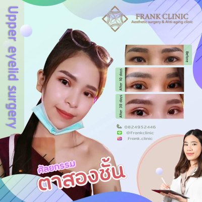 รีวิว ตาสองชั้น