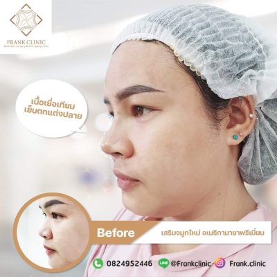 รีวิว เสริมจมูก (Rhinoplasty)