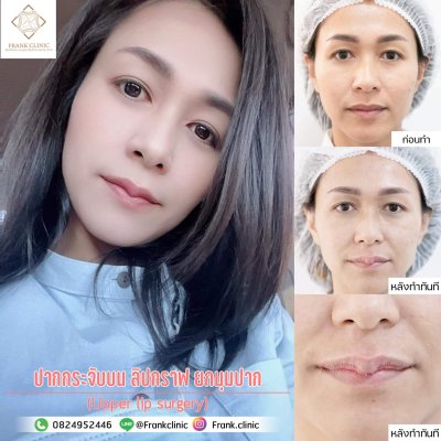 รีวิว ศัลยกรรม ปากกระจับ (Lip surgery)