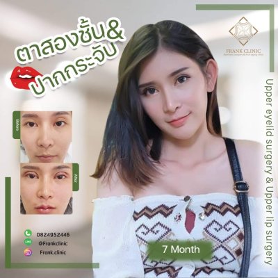 รีวิว ตาสองชั้น