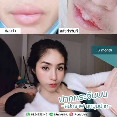 รีวิว ศัลยกรรม ปากกระจับ (Lip surgery)