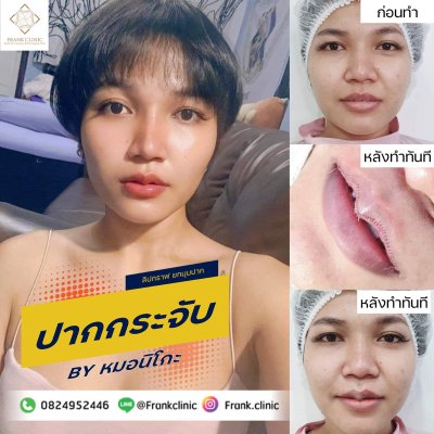 รีวิว ศัลยกรรม ปากกระจับ (Lip surgery)