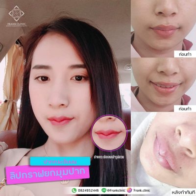 รีวิว ศัลยกรรม ปากกระจับ (Lip surgery)