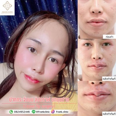 รีวิว ศัลยกรรม ปากกระจับ (Lip surgery)