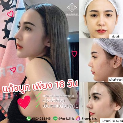 รีวิว เสริมจมูก (Rhinoplasty)