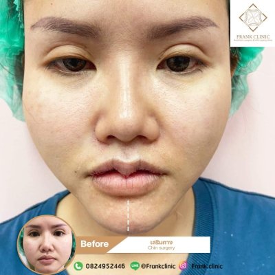 รีวิว เสริมคาง (Chin surgery)