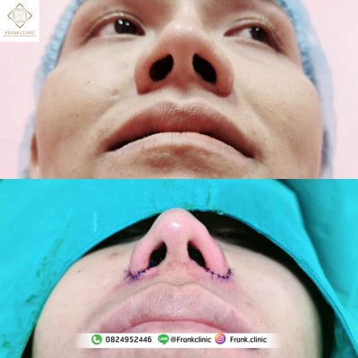 รีวิว เสริมจมูก (Rhinoplasty)