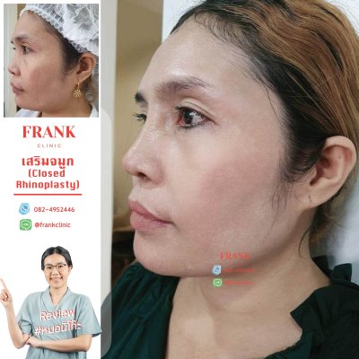 รีวิว เสริมจมูก (Rhinoplasty)