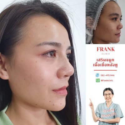 รีวิว เสริมจมูก (Rhinoplasty)