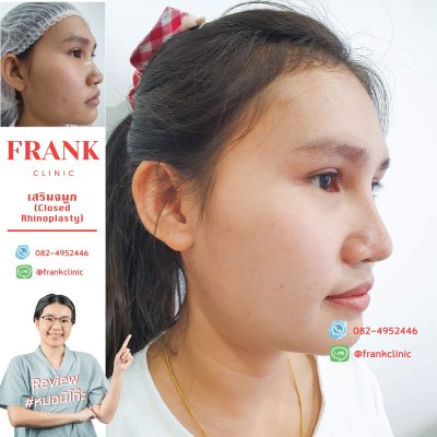 รีวิว เสริมจมูก (Rhinoplasty)