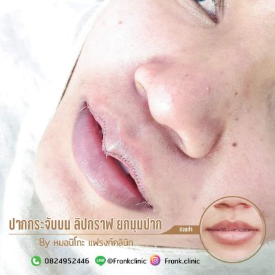 รีวิว ศัลยกรรม ปากกระจับ (Lip surgery)