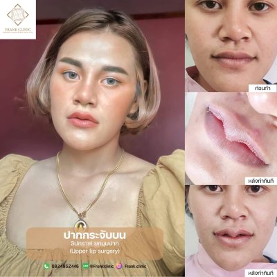 รีวิว ศัลยกรรม ปากกระจับ (Lip surgery)