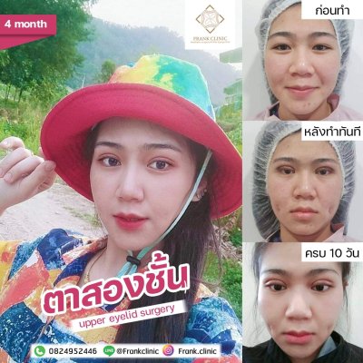 รีวิว ตาสองชั้น