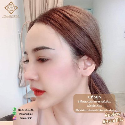 รีวิว เสริมจมูก (Rhinoplasty)