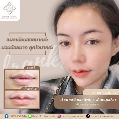 รีวิว ศัลยกรรม ปากกระจับ (Lip surgery)