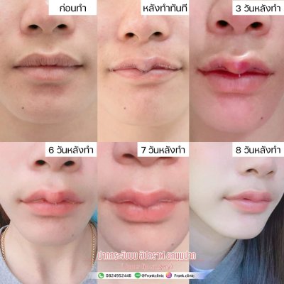 รีวิว ศัลยกรรม ปากกระจับ (Lip surgery)