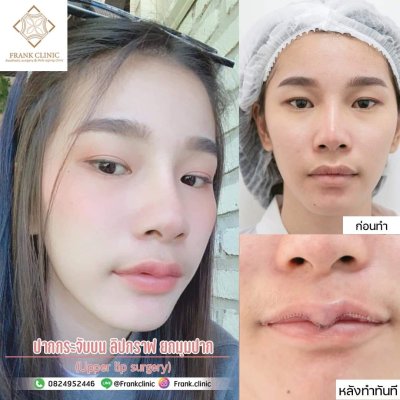 รีวิว ศัลยกรรม ปากกระจับ (Lip surgery)