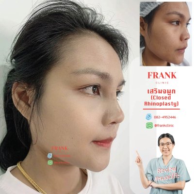 รีวิว เสริมจมูก (Rhinoplasty)