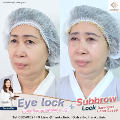 รีวิว เทคนิค EYELOCK ตัดถุงใต้ตา