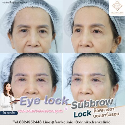 รีวิว ยกคิ้ว เทคนิค SUBBROWLOCK