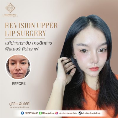 รีวิว ศัลยกรรม ปากกระจับ 2 (Lip surgery)