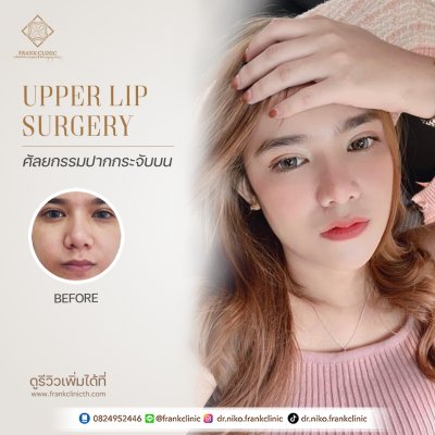 รีวิว ศัลยกรรม ปากกระจับ 2 (Lip surgery)