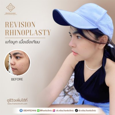 รีวิว เสริมจมูก (Rhinoplasty)