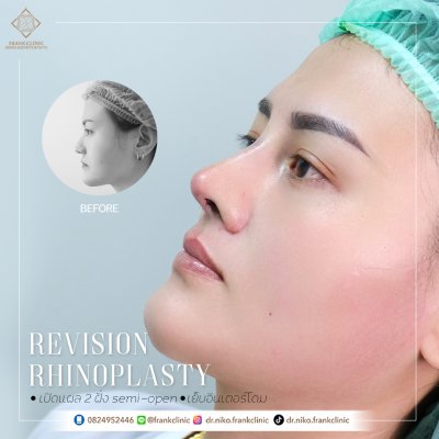 รีวิว เสริมจมูก (Rhinoplasty)