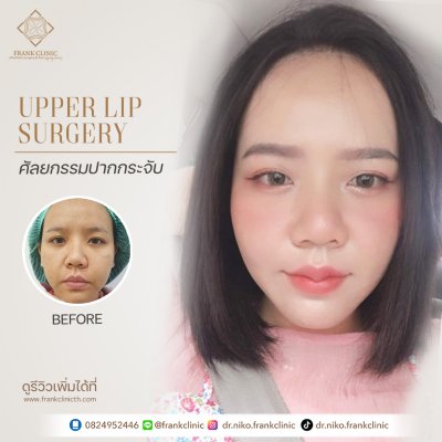 รีวิว ศัลยกรรม ปากกระจับ (Lip surgery)