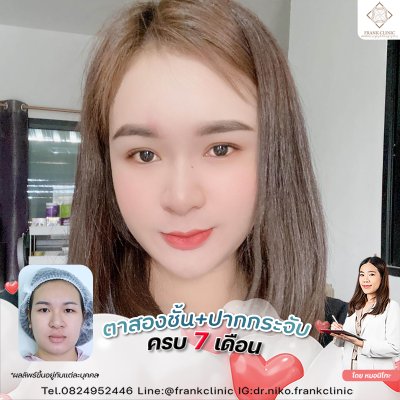 รีวิว ศัลยกรรม ปากกระจับ 2 (Lip surgery)