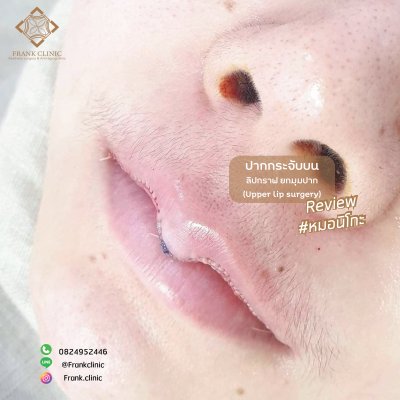 รีวิว ศัลยกรรม ปากกระจับ (Lip surgery)