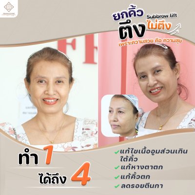 รีวิว ยกคิ้ว เทคนิค SUBBROWLOCK