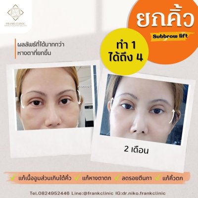 รีวิว ยกคิ้ว เทคนิค SUBBROWLOCK