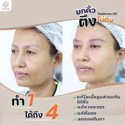 รีวิว ยกคิ้ว เทคนิค SUBBROWLOCK